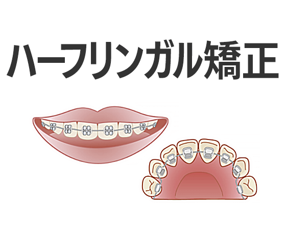 ハーフリンガル矯正