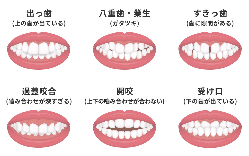 出っ歯、八重歯・業生、すきっ歯、過蓋咬合、開咬、受け口