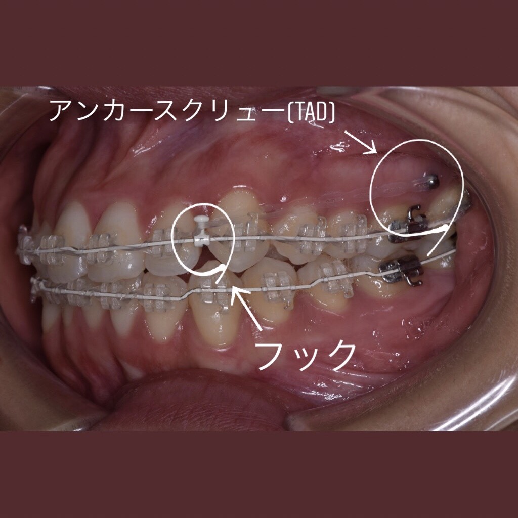 矯正＊TAD アンカースクリュー - 名古屋の矯正歯科・歯列矯正・診療